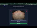 AI Skin Cancer Detection System | Deep Learning Project | Python