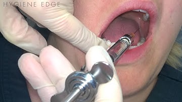 Common Errors on the IA injection