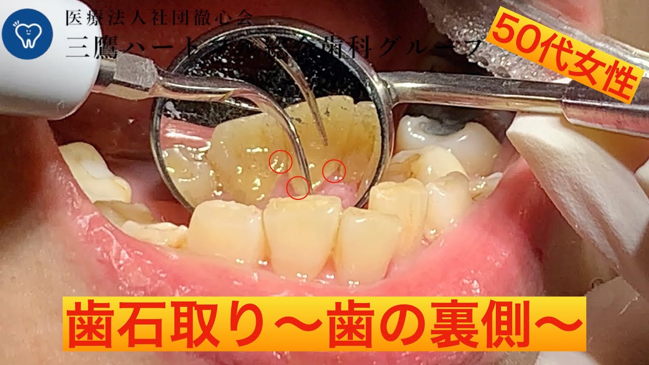 歯 の 裏側 歯石