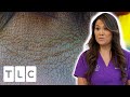 Dr Lee Helps Patient With Atopic Dermatitis | Dr Pimple Popper: This Is Zit