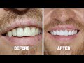 Cosmetic dentistry  smile makeover with zirconium crowns   ilya from the uk