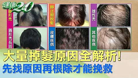 大量掉发原因全解析! 先找原因再根除才能挽救 健康2.0 - 天天要闻