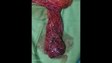 total mesorectal excision " TME" Cancer rectum, Laparoscopic LAR, Dr. Mossad Hemida