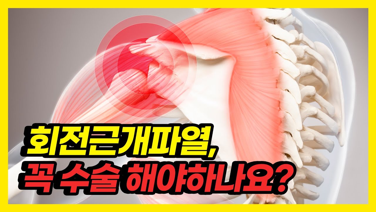 어깨 아픈 회전근개파열, 나도 수술해야할까? - YouTube