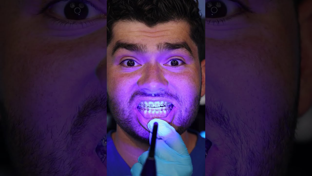 Summer Braces Hack 
