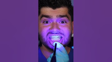 Summer Braces Hack !?