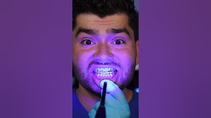 Summer Braces Hack !?