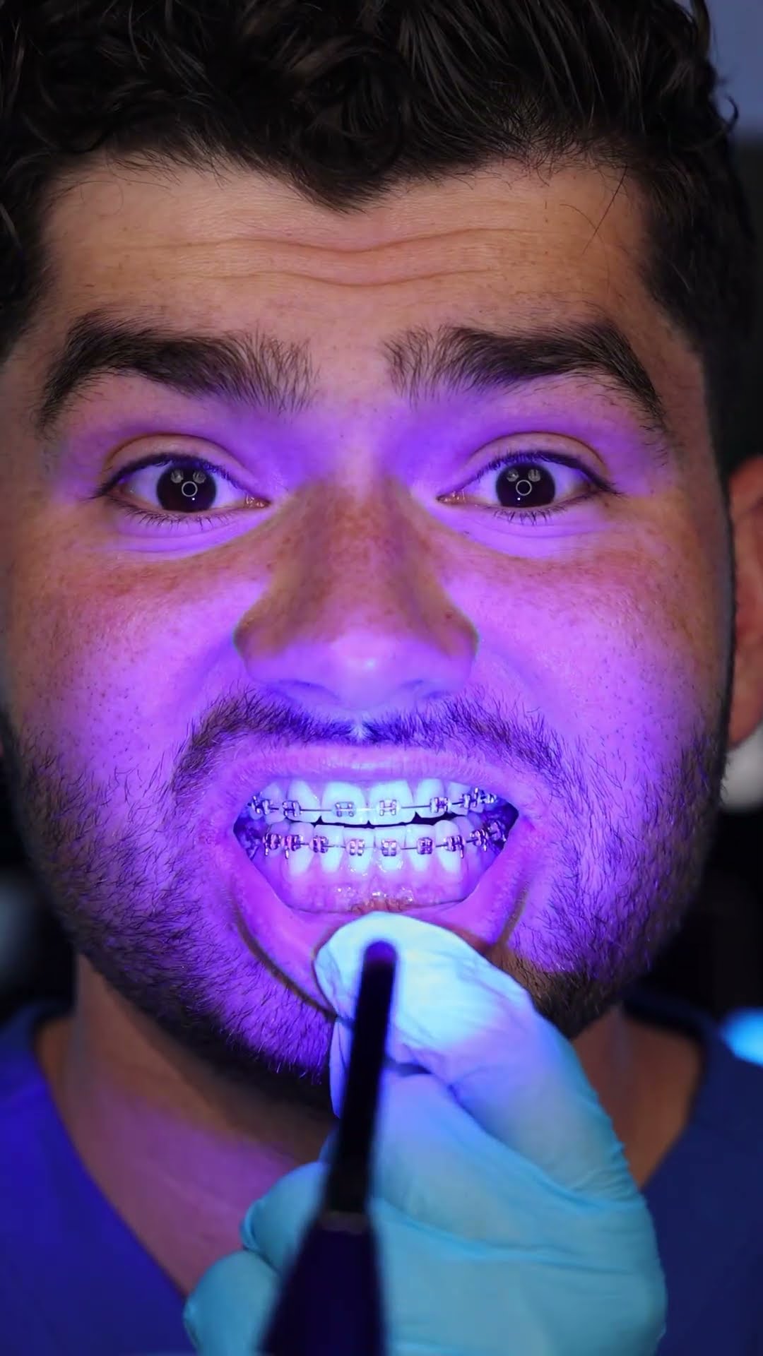 Summer Braces Hack !?