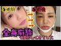 【整形】おでこを形成し喉仏を平らに…全身麻酔による女性化手術の一部始終
