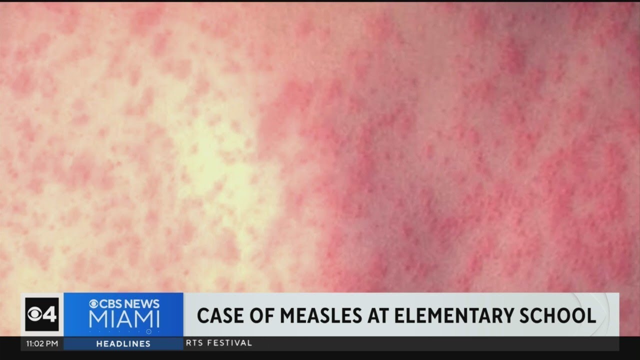 Case of measles detected at Broward elementary school - YouTube