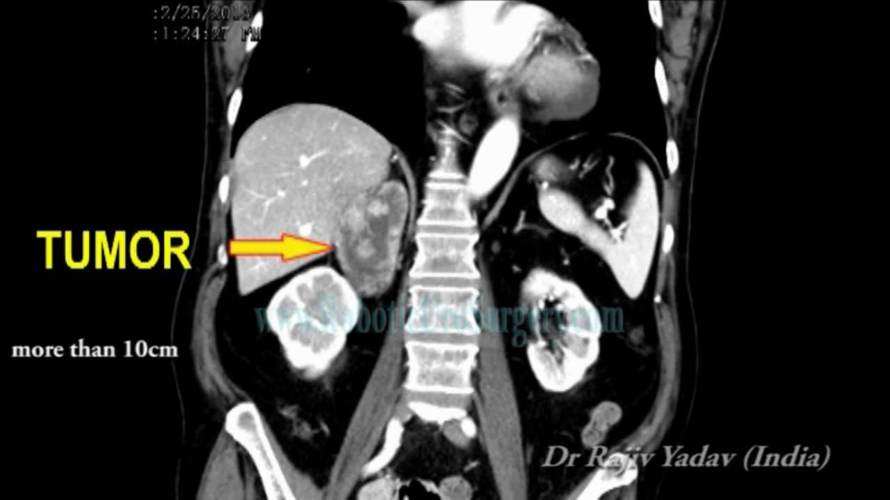 Adrenal cortical cancer_Cancer Surgery in India YouTube