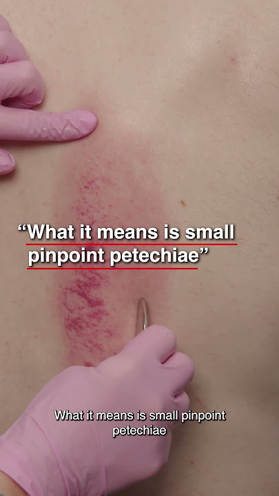 What Is The Meaning Of Gua Sha?