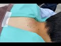 後頸部の大きな粉瘤　くり抜き　炎症がなく、癒着の少なかった症例　ふるばやし形成外科粉瘤クリニック　東京新宿院　大阪梅田形成外科クリニック