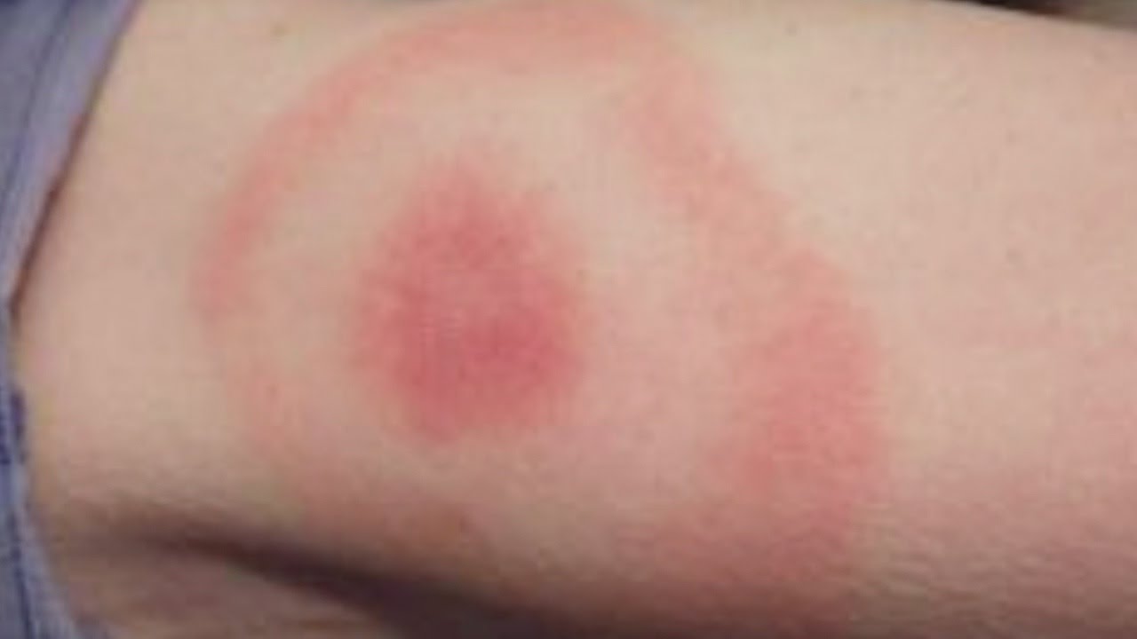 Health Officials Warn COVID-19, Lyme Disease Symptoms Similar