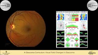 Visual Field Changes in Glaucoma