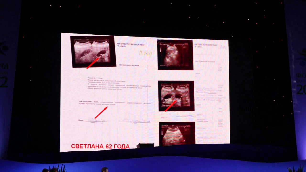 Лечение желчекаменной болезни в Коралловом клубе - YouTube