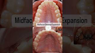 Midfacial Skeletal Expansion MSE before and after