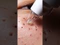 Cheek Cluster Blackhead Removal | Ultra Macro ASMR #cheekblackheads #asmr #porecleaning #macroskin