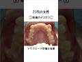 マウスピース型矯正装置による八重歯の治療例 #矯正歯科 #インビザライン #歯医者