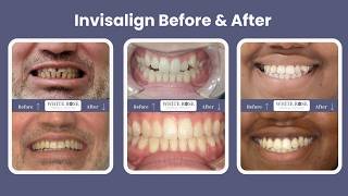 Invisalign Before &amp; After: What to Expect from Treatment in Burlington