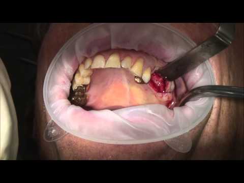 INTRALIFT Sinuslift Live Surgery And Simultaneous Implant Insertion Real Time With German Comments