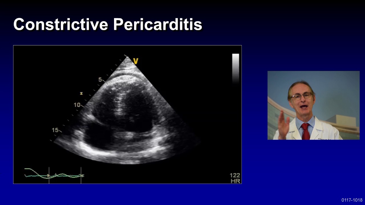pericarditis litfl Treatment of Complicated Pericarditis