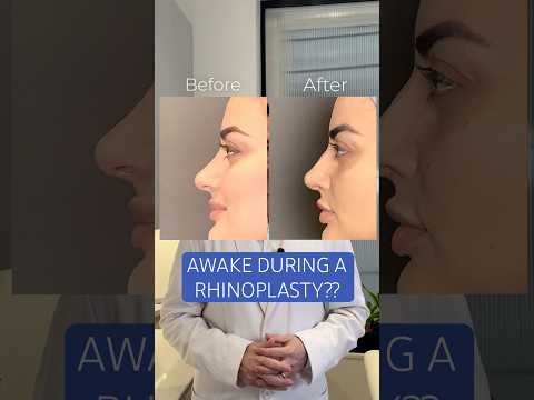 Video thumbnail: Awake During a Rhinoplasty?? Yes! #nosejob · Albert Plastic Surgery New York