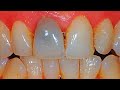 Why is My Tooth Dark After a Root Canal?