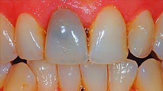 Why is My Tooth Dark After a Root Canal?