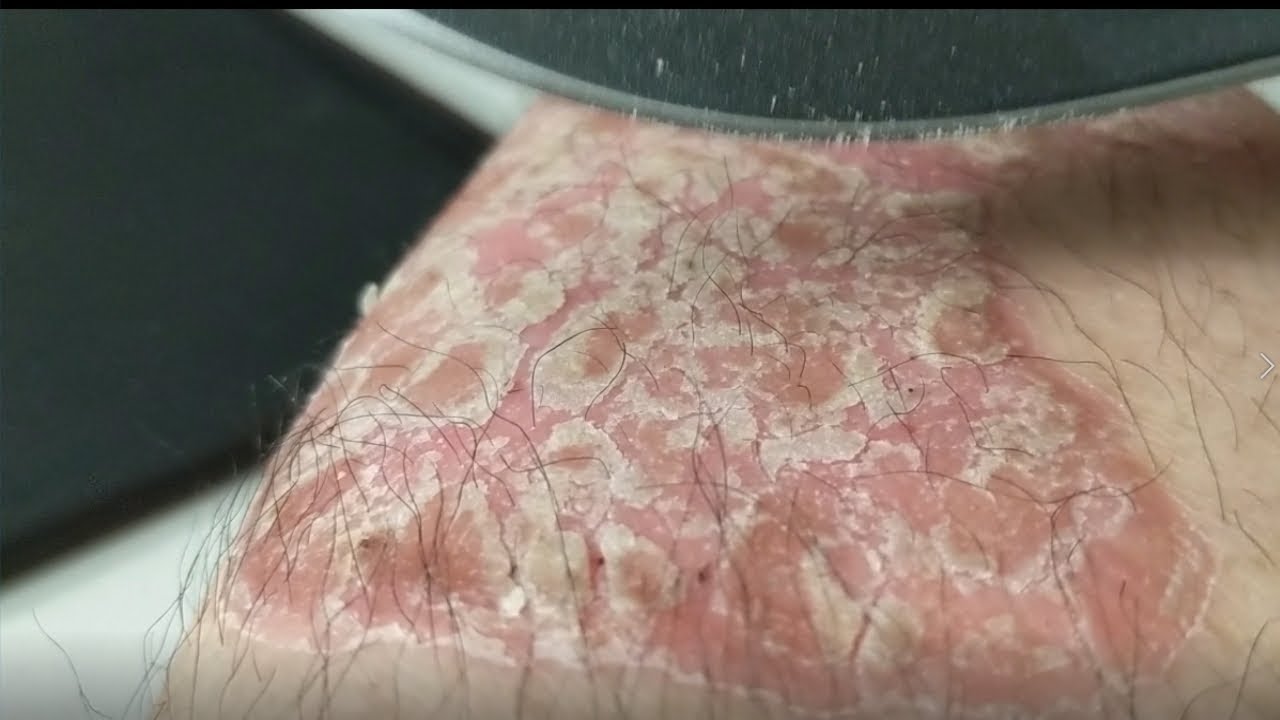 psoriasis flakes in bed