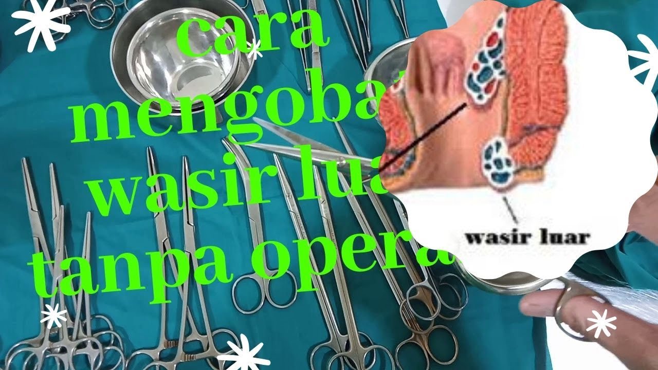 cara mengobati wasir luar tanpa operasi