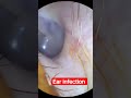 #trending #treatment #earinfection #ent #otoscope #cleansify #portronics #anime