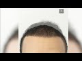 HAIR TRANSPLANT | FUT | AFRO-CENTRIC HAIR | ZIERING MEDICAL