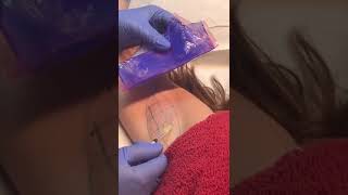 Cómo Eliminar El Exceso De Sudoración En Axilas Con Bótox?