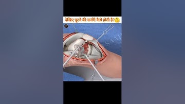 देखिए घुटने की सर्जरी कैसे होती हैं?🤔 || See how knee surgery is done. || #ashwanifactsworld #short