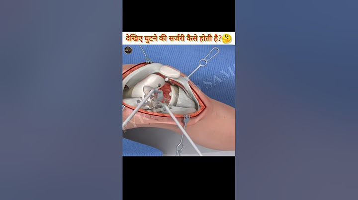 देखिए घुटने की सर्जरी कैसे होती हैं?🤔 || See how knee surgery is done. || #ashwanifactsworld #short