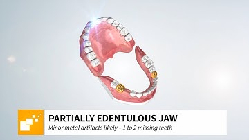 SICAT OPTIGUIDE - 1 to 2 missing teeth / minor metal artifacts