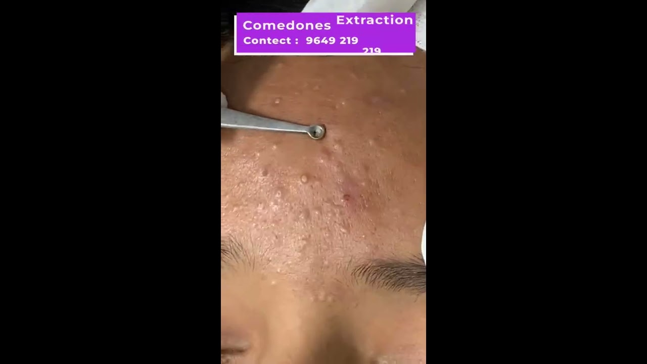 Here S A Quick Way To Solve The Comedones Extraction Problem Viral Shorts