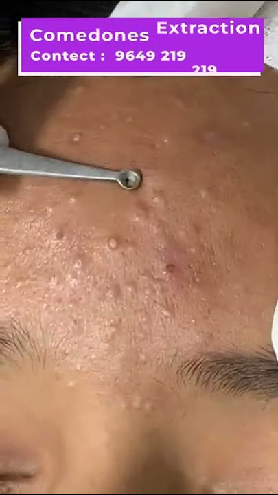 Comedone Extraction Procedure Video | Dermatologist | Comedone Extraction  in Jaipur - YouTube