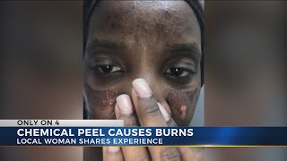 Columbus woman says chemical peel caused second-degree burns on her face Resimi