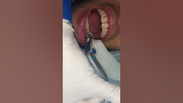 Adiós brackets ¡Descubre el momento MÁGICO de tu nueva sonrisa!