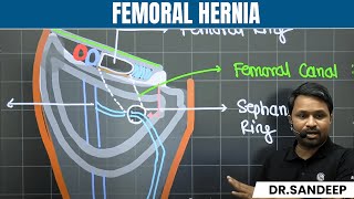 Femoral Hernia | Surgery | Bailey learned with Dr. Sandeep | PW MedEd