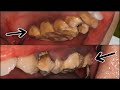 HEAVY CALCULUS TARTAR REMOVAL | Dentist | Dokter Gigi Tri Putra
