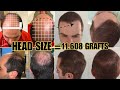 Dr. Pittella Head Size Changes The Number of Grafts- Here's Why