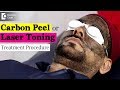 Treating Pigmentation using Carbon Peel | Laser Toning Treatment Video - Dr. Rajdeep Mysore