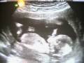 Baby Avirett Ultrasound 2-5-09