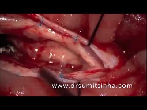 He is an expert Minimally invasive and Endoscopic Neurosurgeon and Spine Surgeon. He has to his credit performing successfully thousands of complex Neurosurgical and Spine operations through keyhole and endoscopic approaches.