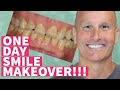 New Teeth in One Day Smile Makeover with Dental Veneers and Crowns