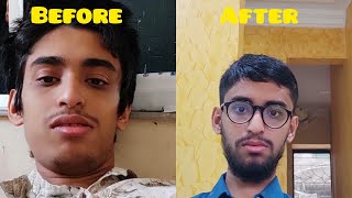 || Minoxidil Beard before after || 6 Months use Results || ❤