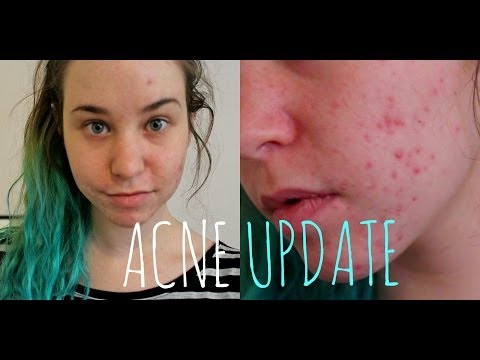 acne-update:-birth-control,-lemon-juice,-and-acne-scars